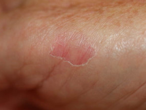 Hipoqueratosis palmar circunscrita