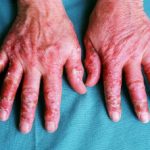 palmar-pustulosis-01__protectwyjqcm90zwn0il0_focusfillwzi5ncwymjisingildizxq-5026984-3317262-jpg-4853863