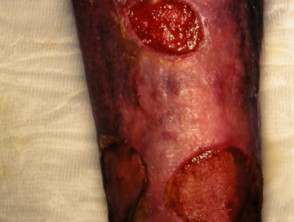 Hautpolyarteritis nodosa