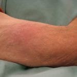 panniculitis-01__protectwyjqcm90zwn0il0_focusfillwzi5ncwymjisingildbd-7394760-9755679-jpg-6070108