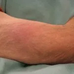 panniculitis-01__protectwyjqcm90zwn0il0_focusfillwzi5ncwymjisingildbd-7394760-9755679-jpg-6070108