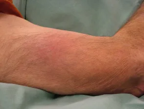 stafylokokken panniculitis