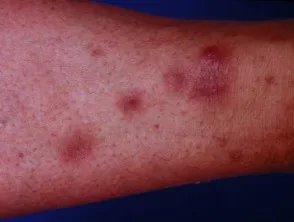 infectieuze panniculitis