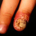 parakeratosis1__protectwyjqcm90zwn0il0_focusfillwzi5ncwymjisingildfd-6607122-2553790-jpg-6582009