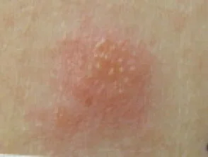 Patch test positivo per tiosolfato di sodio (oro)