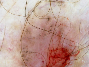 Dermatoscopia de carcinoma de células basales pigmentado