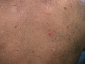 Carcinoma cistico adenoide cutaneo primario