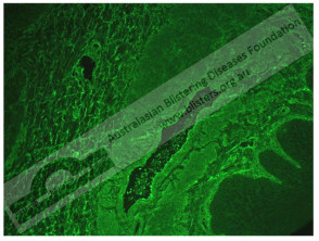 Inmunofluorescencia indirecta del pénfigo foliáceo