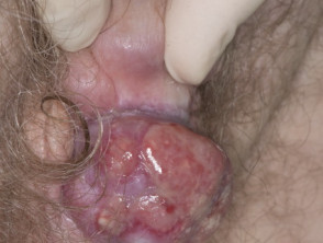 Carcinoma de células escamosas de pene