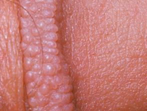 Pápulas perladas del pene