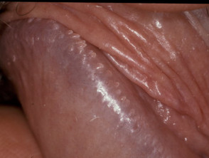 Pápulas perladas del pene