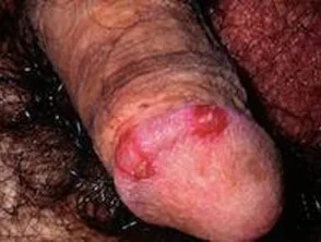 Psoriasis des Penis