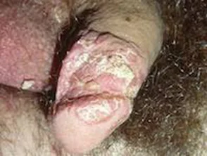 Psoriasis des Penis