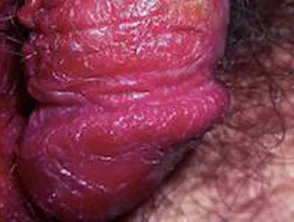 Psoriasis des Penis