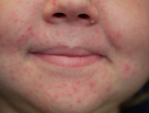 Dermatite periorifiziale in un bambino