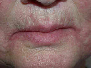 Angular Cheilitis