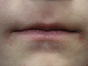 Angular Cheilitis