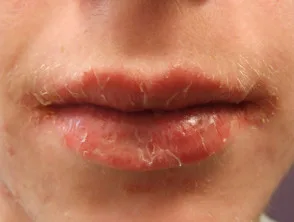 Queilitis angular