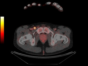 Tomografía por emisión de positrones (PET-CT) que revela melanoma metastásico en la ingle