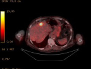 Imagen fusionada de PET / CT de metástasis hepática