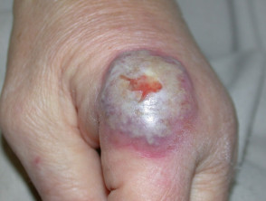 Dermatosis neutrofílica de manos dorsales