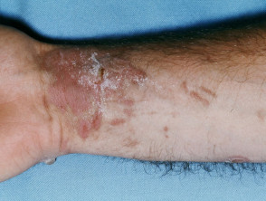 Fitofotodermatitis pigmentaria
