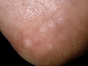 piezogenic-papules1__protectwyjqcm90zwn0il0_focusfillwzi5ncwymjisinkildm2xq-3925530-4908181-jpg-8782581