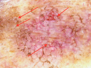 Círculos concéntricos (flechas rojas) observados en dermatoscopia de queratosis actínica pigmentada