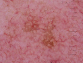 Patrón granular anular visto en la queratosis actínica pigmentada