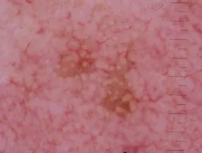 Patrón granular anular visto en la queratosis actínica pigmentada