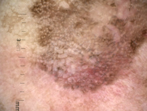 Patrón granular anular visto en dermatoscopia de queratosis actínica pigmentada