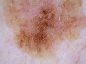 Dermatoscopia de queratosis actínica pigmentada