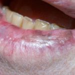 pigmented-cheilitis1__protectwyjqcm90zwn0il0_focusfillwzi5ncwymjisinkildzd-3868027-4939504-jpg-1483895