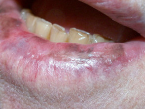 pigmented-cheilitis1__protectwyjqcm90zwn0il0_focusfillwzi5ncwymjisinkildzd-3868027-4939504-jpg-1483895