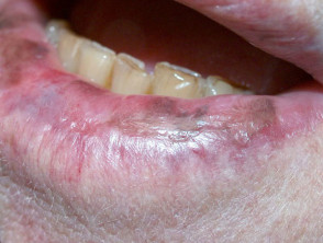 Liquen plano pigmentoso del labio inferior