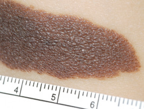 Nevus melanocítico congénito pigmentado