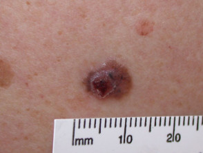 Carcinoma de células basales pigmentado
