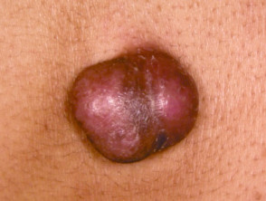 Dermatofibrosarcoma pigmentado