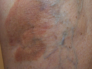 Dermatofibroma pigmentado