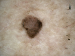 Carcinoma de células escamosas pigmentado in situ