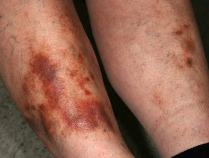 Dermatitis purpúrica pigmentada