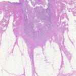 pilonidal-sinus-figure-1__protectwyjqcm90zwn0il0_focusfillwzi5ncwymjisinkildcwxq-3060995-8241515-jpg-5626326