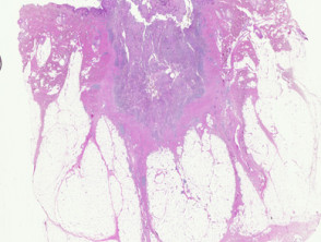 Patología del seno pilonidal
