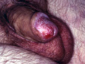 Neoplasia intraepitelial de pene