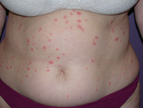 pityriasis rosea