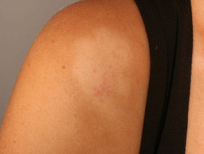 pityriasis-alba-2__protectwyjqcm90zwn0il0_focusfillwzi5ncwymjisingildfd-9916018-3179296-jpg-1633823