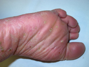 Plantarpustulose