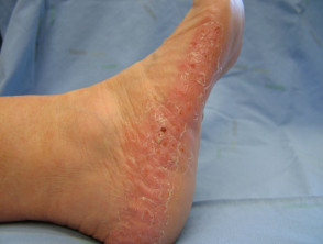 Plantarpustulose