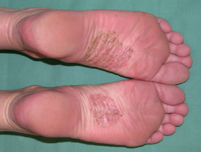 Pustulosis plantar