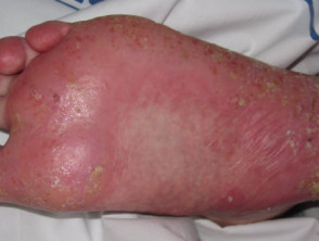 Pustulosis plantar